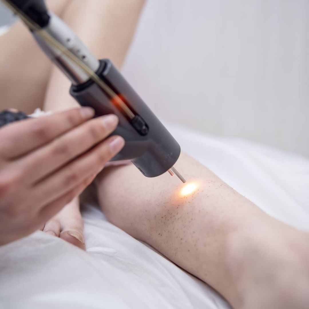 The cost of laser hair removal